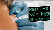 How to Quickly and Easily Remove Skin Tags at Home (Using Things You Already Own)