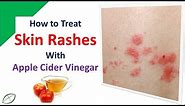 How to Treat Skin Rashes with Apple Cider Vinegar