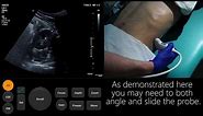 Ultrasound Tutorial: Kidney & Bladder / Urinary Tract | Radiology Nation