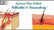 Infected hair follicle. What to do? Causes, Location, & Treatment-Dr. Rasya Dixit | Doctors' Circle