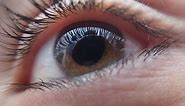 Síndrome de Adie (pupila tónica de Adie): causas, síntomas, diagnóstico, tratamiento, pronóstico