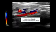 Occlusion of the common carotid artery: collateral pathway | Ultrasound