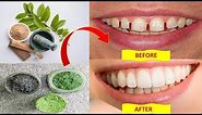 How to fix gap between teeth naturally at home without braces - Health Pavilion BRIGHT SIDE