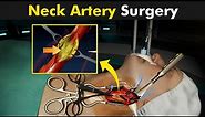 Carotid Endarterectomy Surgery - How Is Plaque Removed From Carotid Artery?