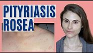 PITYRIASIS ROSEA: WHAT IT IS & GETTING RID OF IT| DR DRAY