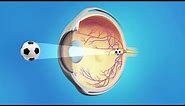 Cirugía Ocular LASIK
