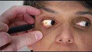5. How to Assess the Conjunctiva