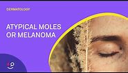 Atypical Moles or Melanoma: The ABCDE's [Dermatology]