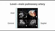 How to identify normal heart structures on a cardiac CT scan.