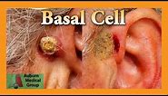Basal Cell Carcinoma | Auburn Medical Group