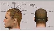 SCALP ACUPUNCTURE: Locations and Indications of Areas (Jiao SA)