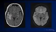 Imaging brain tumors - 5 - Non glial tumors