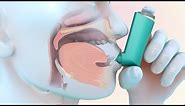 How to Use a Metered-Dose Inhaler