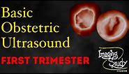 Basic Obstetric Ultrasound: First Trimester Pregnancy