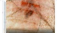 Morgellons the Cause Glass Worm