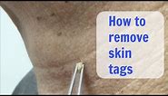 Painless Cryo Skin Tags removal - Cosmetic Institute of Australia