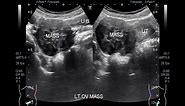 Ultrasound Video showing an Ovarian tumor.