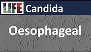 Oesophageal Candida