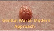 Genital Warts: Modern Approach