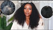 THESE TIPS GREW MY NATURAL 4C HAIR FROM BALD TO THICK IN LESS THAN 2 YEARS | HAIR + SCALP TREATMENT