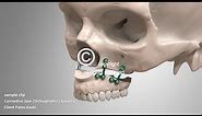 Corrective Jaw Surgery Orthognathic
