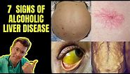 Doctor outlines 7 signs of Alcoholic Liver Disease (ascites, Caput Medusae, jaundice & more)