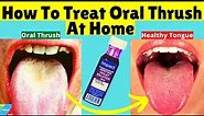How To Treat Oral Thrush At Home | How to Treat Candida at Home