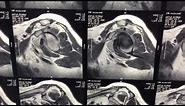 Shoulder: Rotator Cuff Tears Explained on MRI