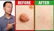 How to Rid Skin Tags and Warts Within 24 Hours - Dr. Berg on Skin Tag Removal