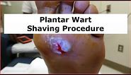 Plantar Wart Shaving Procedure