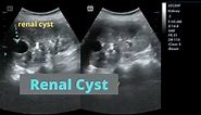 Renal ultrasound showing a renal cyst | Lesion