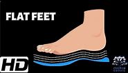 FLAT FEET: Everything You Need To Know