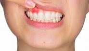 Tooth Abscess and Jaw Bone Infection: What You Need to Know