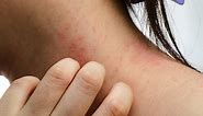 How To Treat Contact Dermatitis
