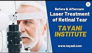 Laser Treatment of Retinal Tear | Tayani Institute