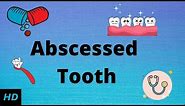 Abscessed tooth, Causes, SIgns and Symptoms, Diagnosis and Treatment