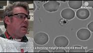 Malaria parasites invading human red blood cell