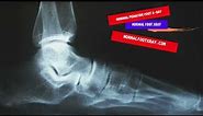18 Normal Pediatric Foot X Ray