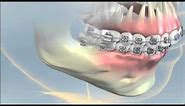 Hayward Braces: Jaw Surgery for Small Lower Jaw