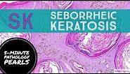 Seborrheic Keratosis: 5-Minute Pathology Pearls