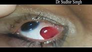 Conjunctival Pyogenic Granuloma Excision Video Under Topical Anesthesia #122