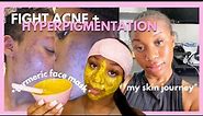 HOW TO GET CLEAR SKIN IN 2024 #1 | EASY DIY TURMERIC FACE MASK TUTORIAL FOR ACNE & HYPERPIGMENTATION