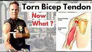 Torn or Ruptured Bicep Tendon? What you need to know !!