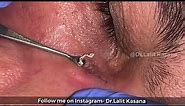 Deep Blackheads Removal from Cheeks and Nose - Best Blackheads Removal Video II Dr lalit kasana II
