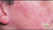A 'Rash' Of Fifth Disease Making The Rounds In North Texas