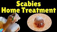 Scabies Home Treatment | Home Remedies for Scabies to Speed Up Treatment | How to Treat Scabies
