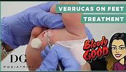 Verrucas plantar warts on feet treatment: Cryotherapy and Salicylic acid on 3 areas | DG Podiatrist