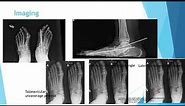 Foot and ankle 1:PTTD (posterior tibial tendon dysfunction) AAFD (adult acquired flatfoot deformity)