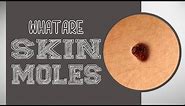 What are Skin Moles?