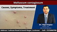 Molluscum contagiosum : Causes, Symptoms, Treatment